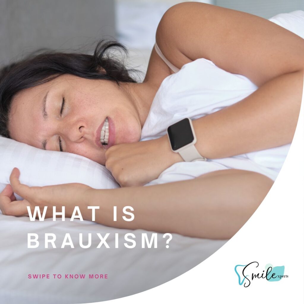 Understanding Bruxism Causes Symptoms Remedies And Faqs Smile